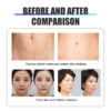 Micro needle frequency division RF micro needle slimming face firming skin frequency division gold RF micro needle machine
