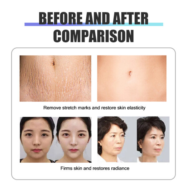 Micro needle frequency division RF micro needle slimming face firming skin frequency division gold RF micro needle machine